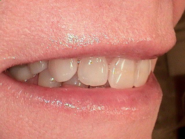 before dental veneers photo