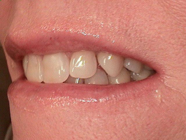 before dental veneers photo